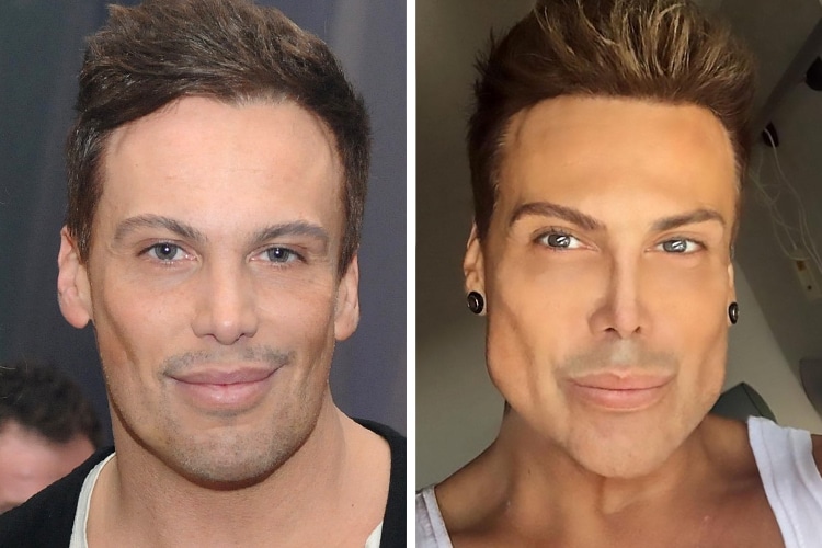 Neven Ciganovic sebelum dan sesudah operasi plastik pada wajahnya, termasuk hidung, bibir dan pipi. (NEW YORK POST)